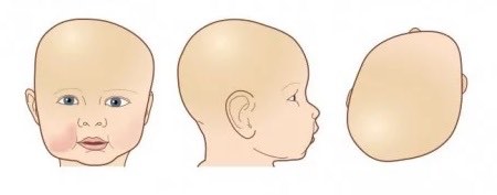 Cranial Remolding Helmets | Coastal P&O